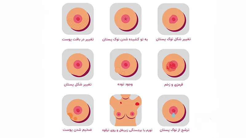 همه چیز درباره سرطان سینه: از تشخیص تا درمان 3 علائم سرطان سینه