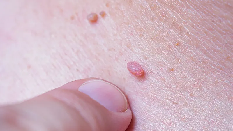 چرا باید واکسن گارداسیل (HPV) بزنیم؟ 1 واکسن گارداسیل (HPV) برای زگیل تناسلی